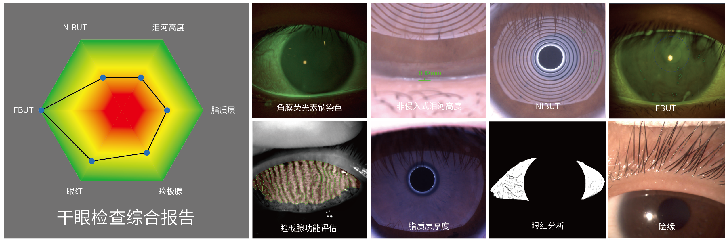 ICL近视手术记录（上海爱尔眼科） - 知乎