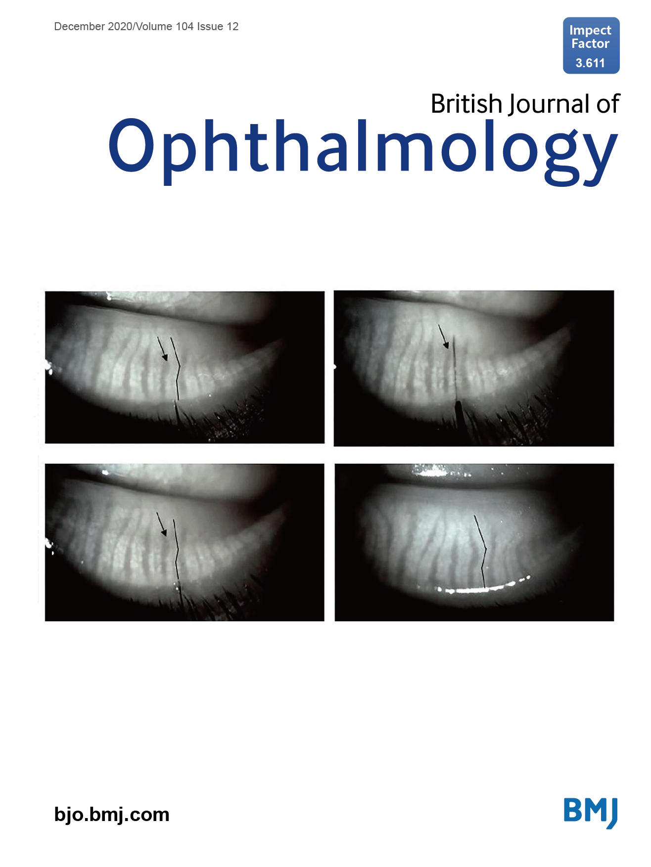 前沿动态| Dr.Maskin对MGD诊断与疏通治疗的新研究荣登《英国眼科期刊》封面！